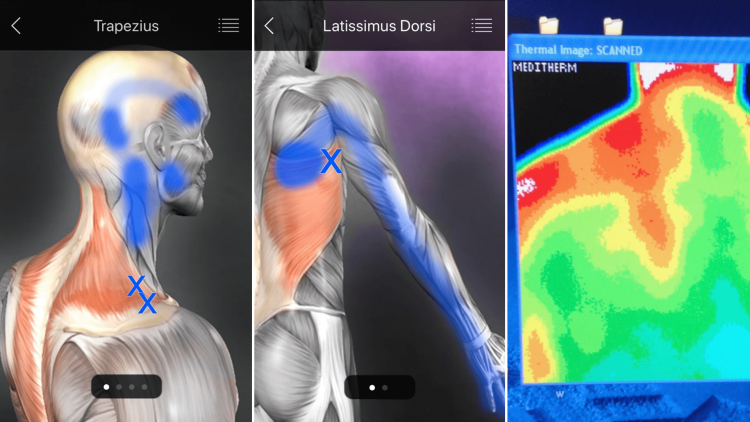 Shoulder Injury Trigger Points and Infrared